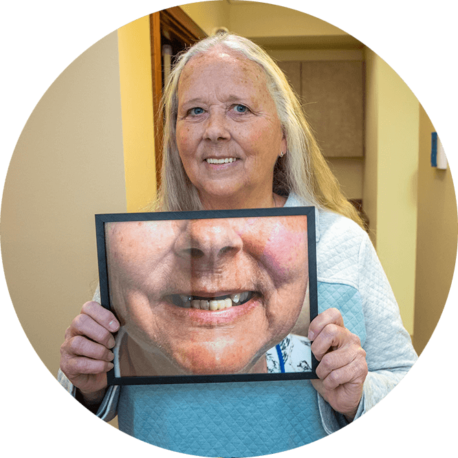 zygomatic implants patient