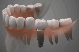 3D rendering of a dental implant with a crown, illustrating how dental implants restore missing teeth for a natural smile.