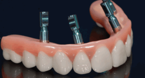 Example of Zirconia Dental Implants.
