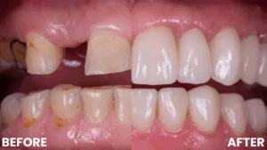 Before and after example of a Dental Implant Procedure