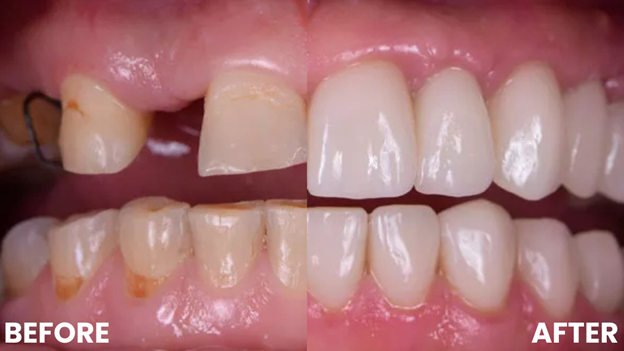 Before and after example of a Dental Implant Procedure