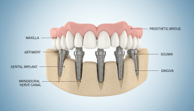 Diagram showing a full arch of teeth supported by four dental implants in the jaw.