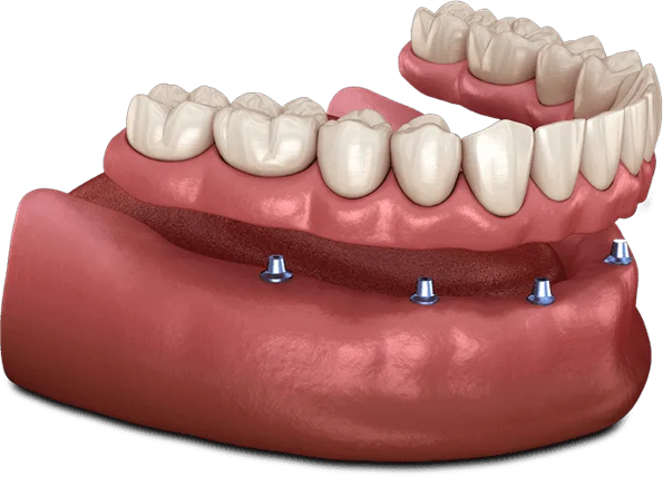 Removable Implant Teeth